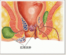 肛周脓肿示意图