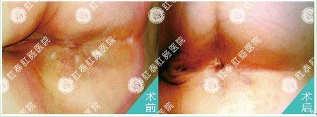 高频电镊技术治疗肛周脓肿对比图