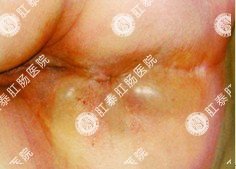 肛周脓肿实例图