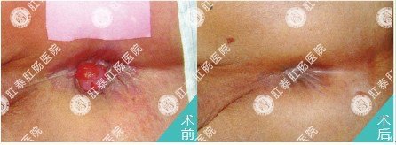 高频电镊技术治疗痔疮引起的肛门瘙痒