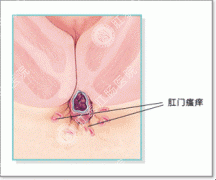 肛门瘙痒示意图